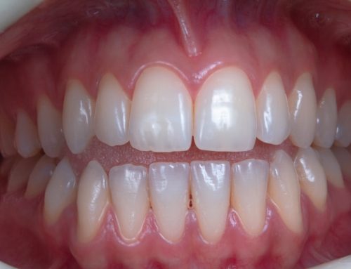 Receding Gums: What It Means and How It’s Treated